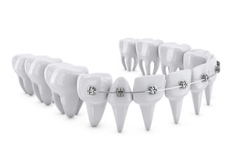 新琴似（札幌市北区）の歯医者、ふれあいの杜歯科・こども歯科の大人の矯正歯科