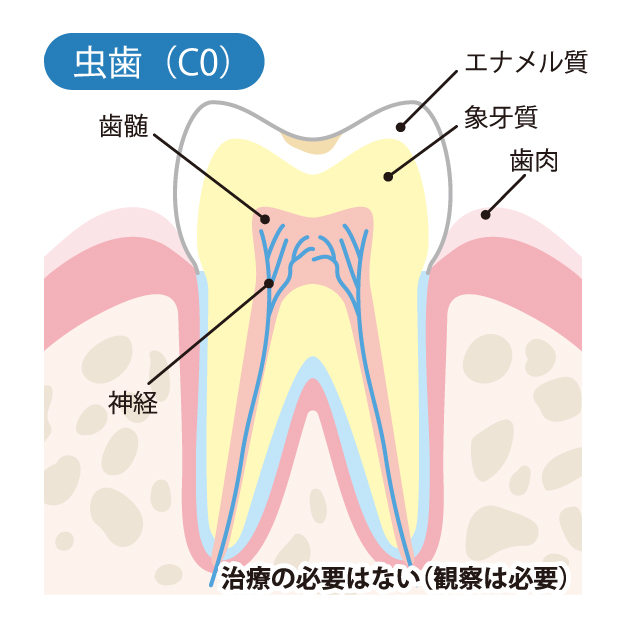 新琴似（札幌市北区）の歯医者、ふれあいの杜歯科・こども歯科のむし歯治療