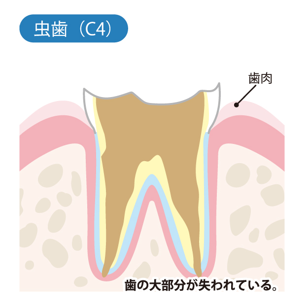 新琴似（札幌市北区）の歯医者、ふれあいの杜歯科・こども歯科のむし歯治療
