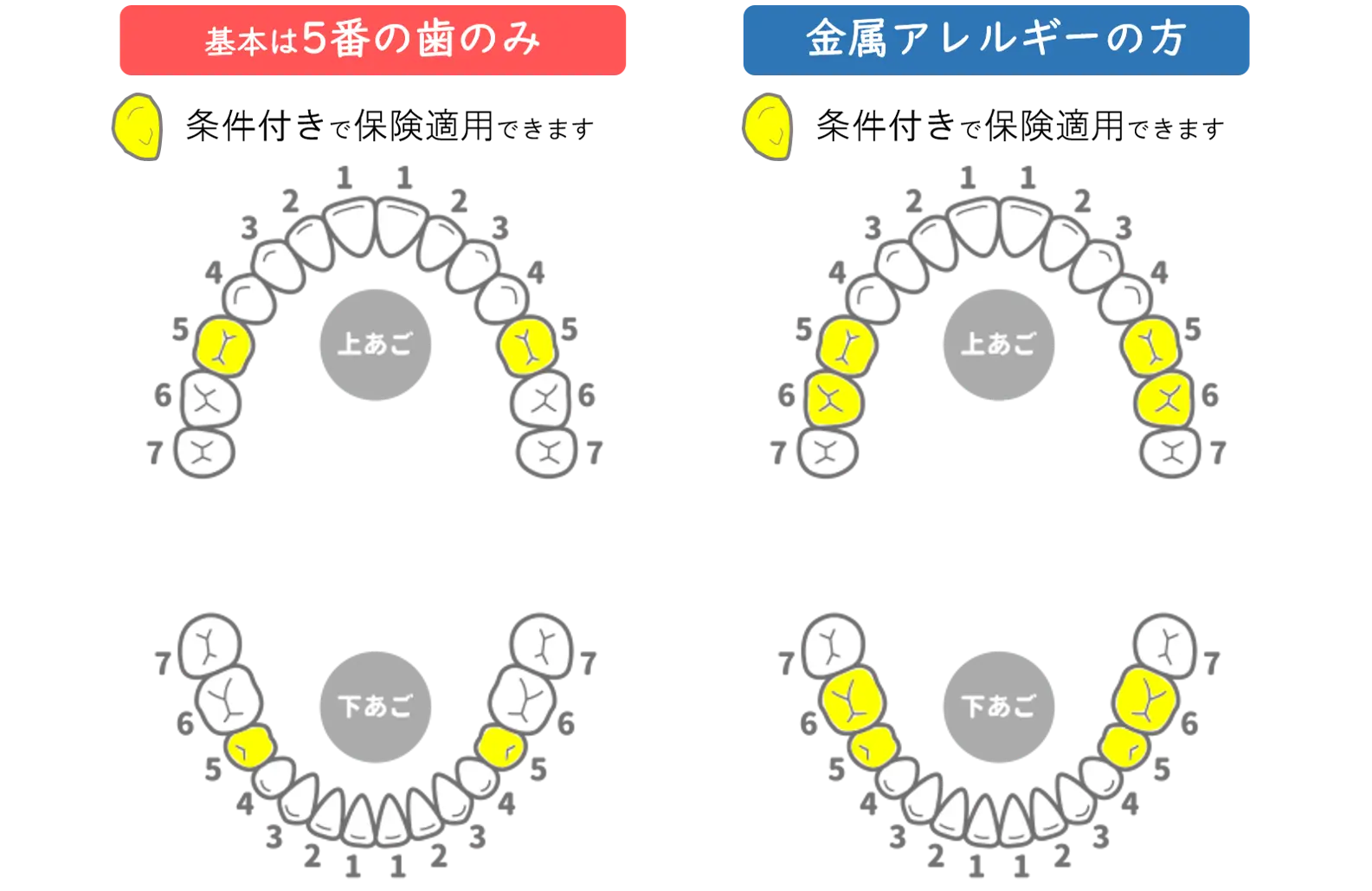 新琴似（札幌市北区）の歯医者、ふれあいの杜歯科・こども歯科の保険適用の白い歯