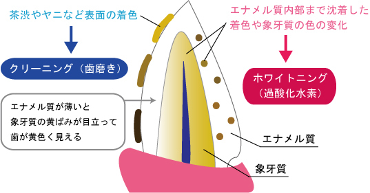 新琴似（札幌市北区）の歯医者、ふれあいの杜歯科・こども歯科のホワイトニング